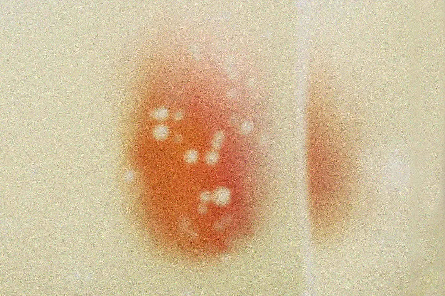What's Causing the Eczema on Your Face?