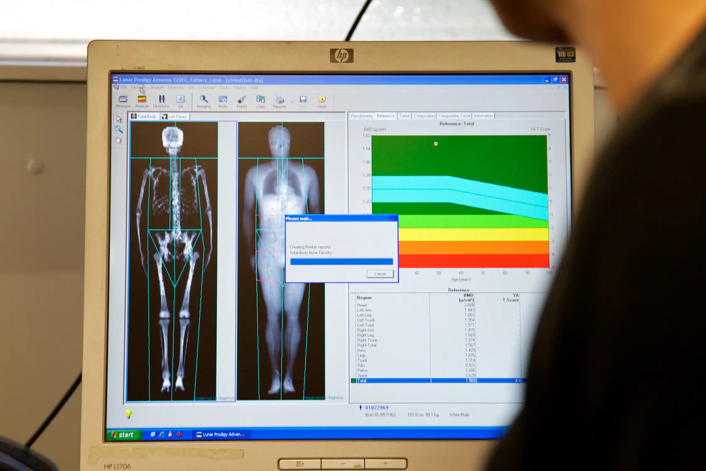 The DEXA Scan: The Most Overlooked Longevity Test for Women in Their 30s and 40s