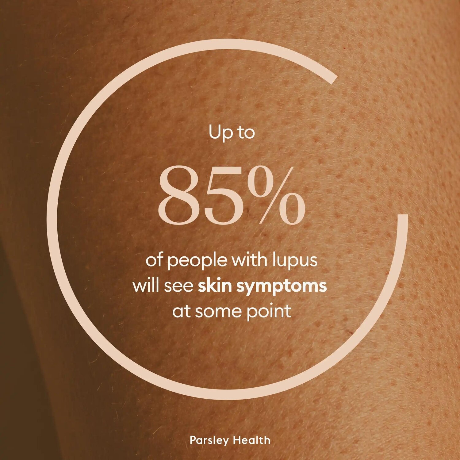 12 Early Signs of Lupus in Females: Symptoms Women Should Know ...