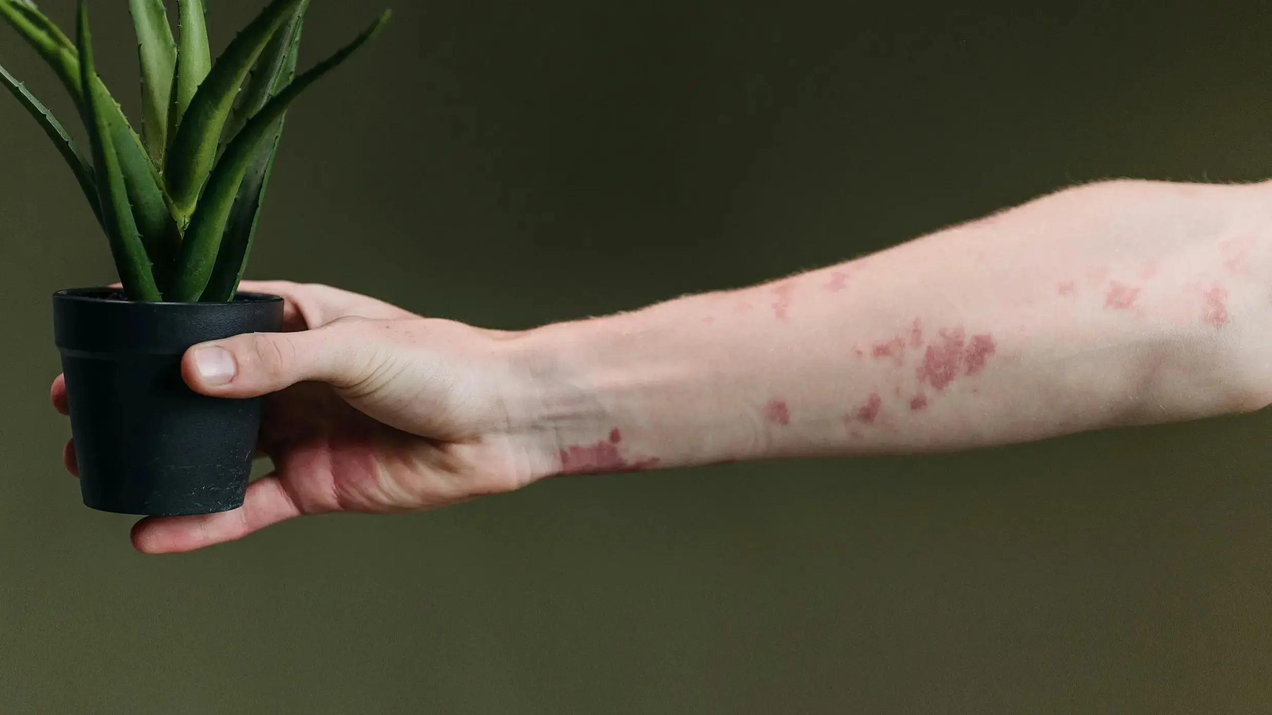 Autoimmune Rash: Types, Causes, and Treatment Options | Parsley Health