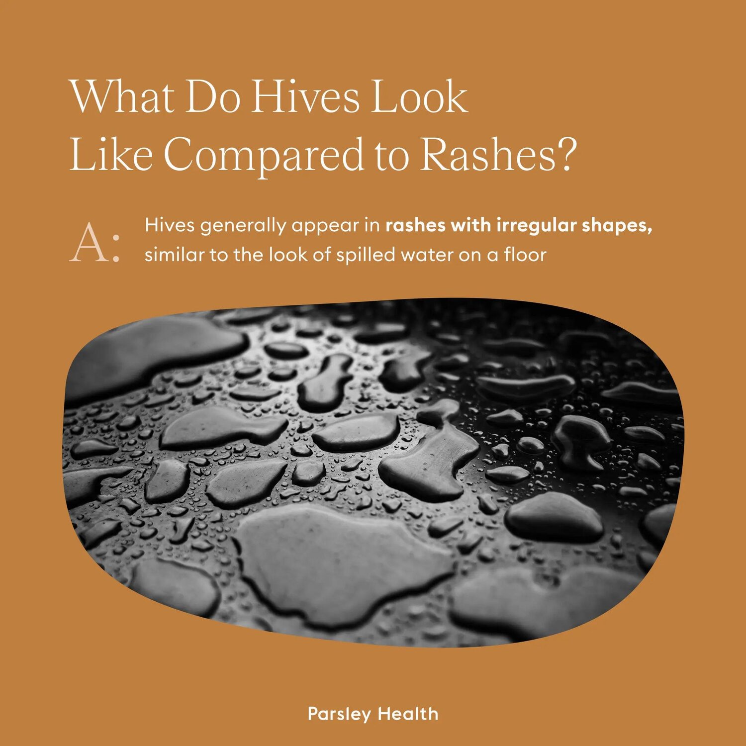 Hives vs Rash: Key Differences, Symptoms, Diagnosis, & Treatment